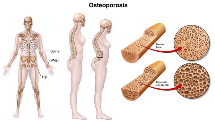 What is the main cause of osteoporosis?
